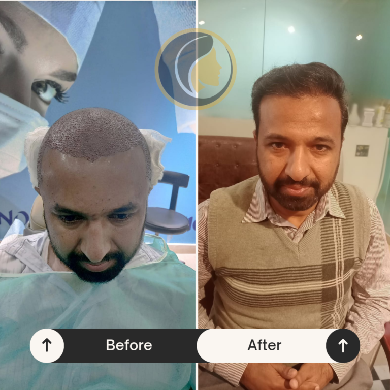 Patient’s before and after FUE hair transplant results at De Nova Aesthetic Clinic, performed by the best dermatologist in Rawalpindi.