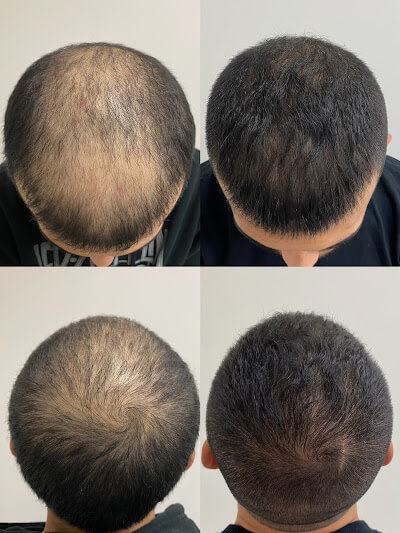 Benefits | Denova Aesthetic Clinic